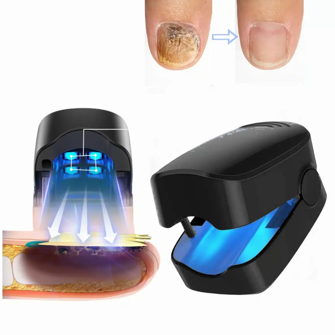 kf-Sd62f3224389346fbb93fb5b8c7a43d9cm Nail Fungus LED Laser - Image 1